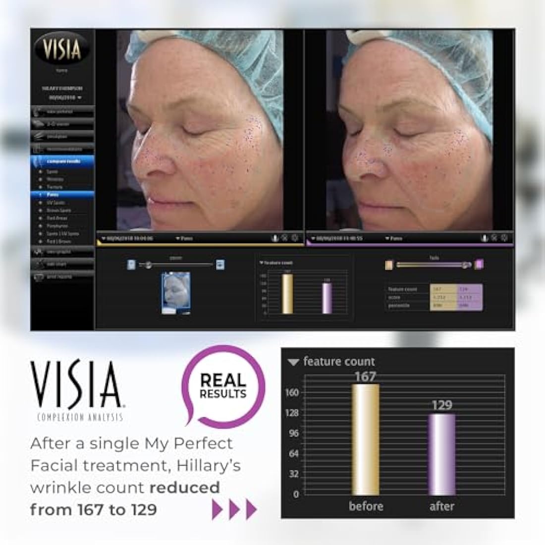 My Perfect Facial, Penny Lane, 10 Treatment Kit, Instant Results, Clinically Proven, Anti-Ageing 3-Stage Facial Contouring and Skin Tightening System. Salon Grade Results, As Seen on TV.