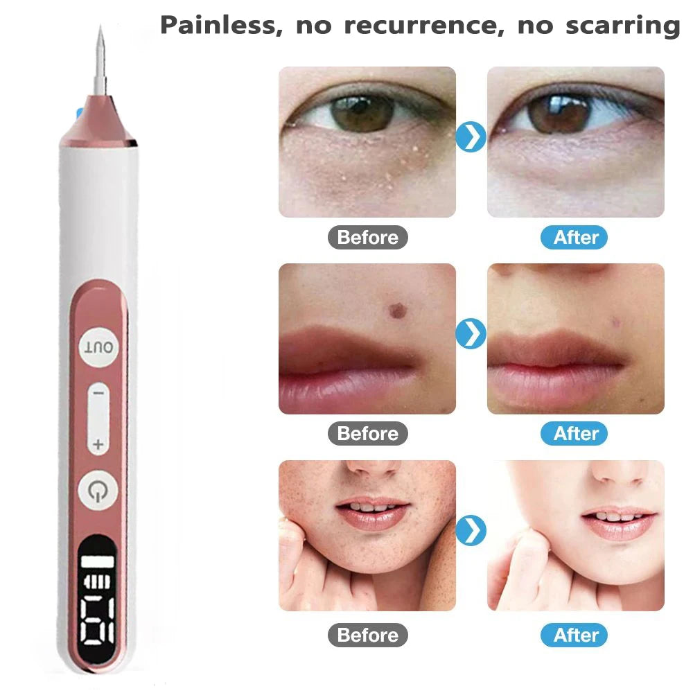 Skin Tag Remover Wart Eliminator Laser Plasma Pen Papillomas Electric Freckle Dark Spot Mole Removal Skin Tag Remover Pen