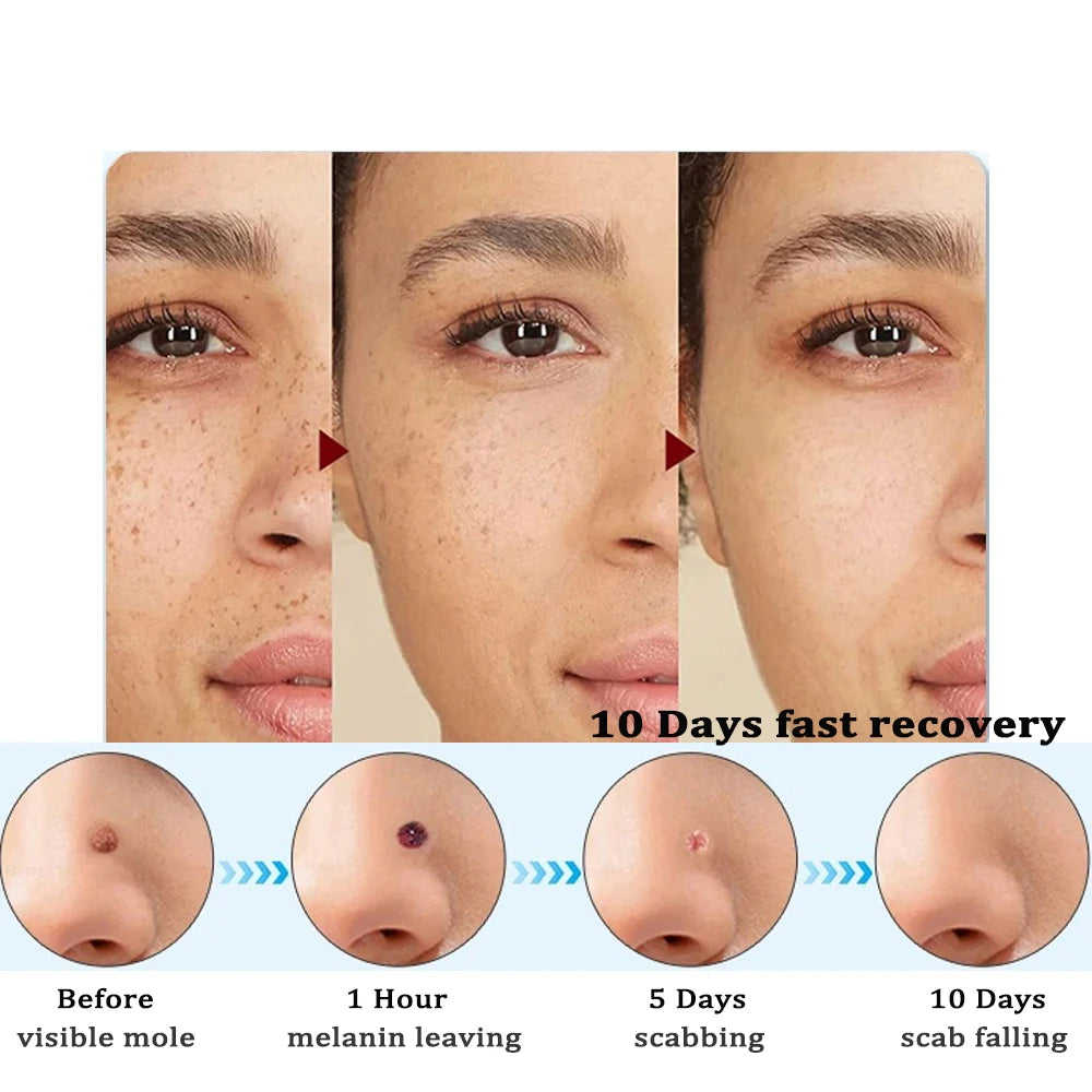 Skin Tag Remover Wart Eliminator Laser Plasma Pen Papillomas Electric Freckle Dark Spot Mole Removal Skin Tag Remover Pen