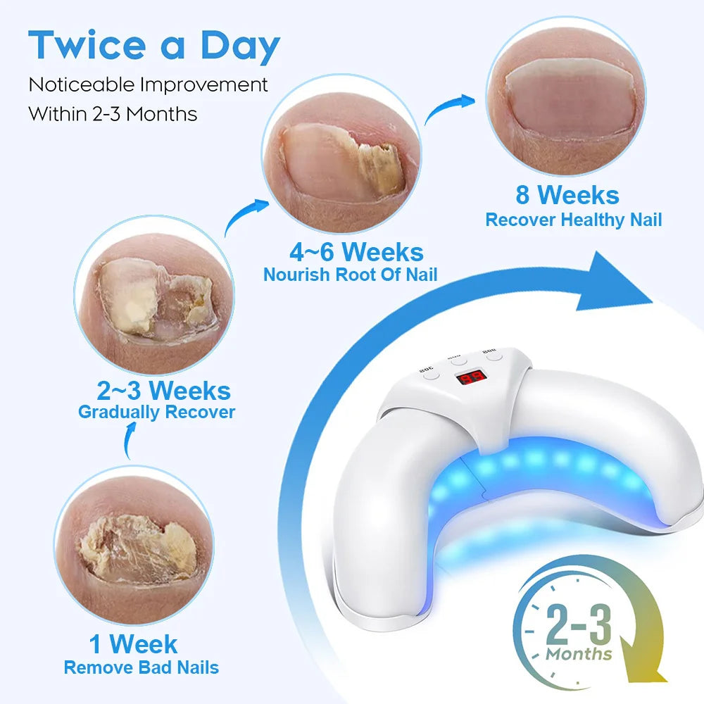 New Fungal Nail Laser Device Repair Toenail Fingernail Treatment Anti Fungus Infection Paronychia Onychomycosis Ingrown Toenail